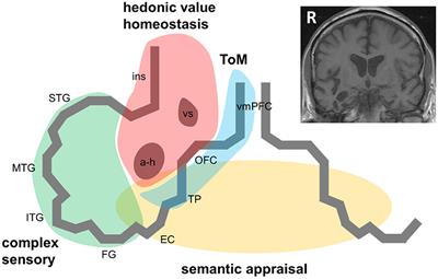 The problematic syndrome of right temporal lobe atrophy: Unweaving the phenotypic rainbow